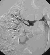 Estudio ASTRAL: La angioplastia renal no es efectiva